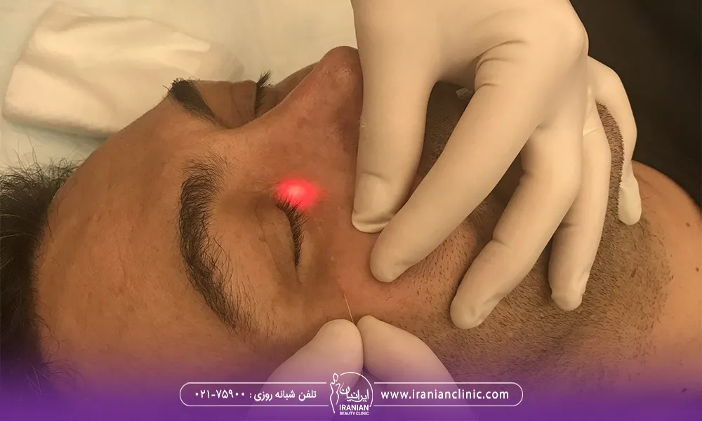 پزشک رد حال انجام اندولیفت برای یک آقا است