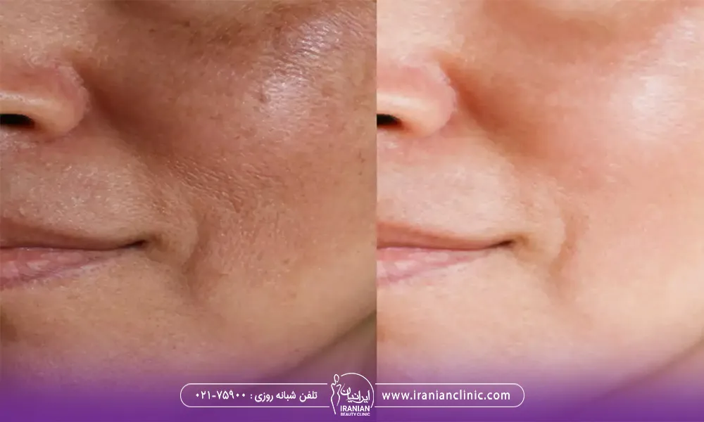 عکس قبل و بعد استفاده از لیزر اندولیفت برای از بین بردن منافذ باز پوست است