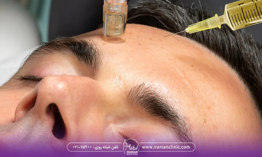 آقایی که برای لک های پیشانیش در حال انجام مزونیدلینگ است.