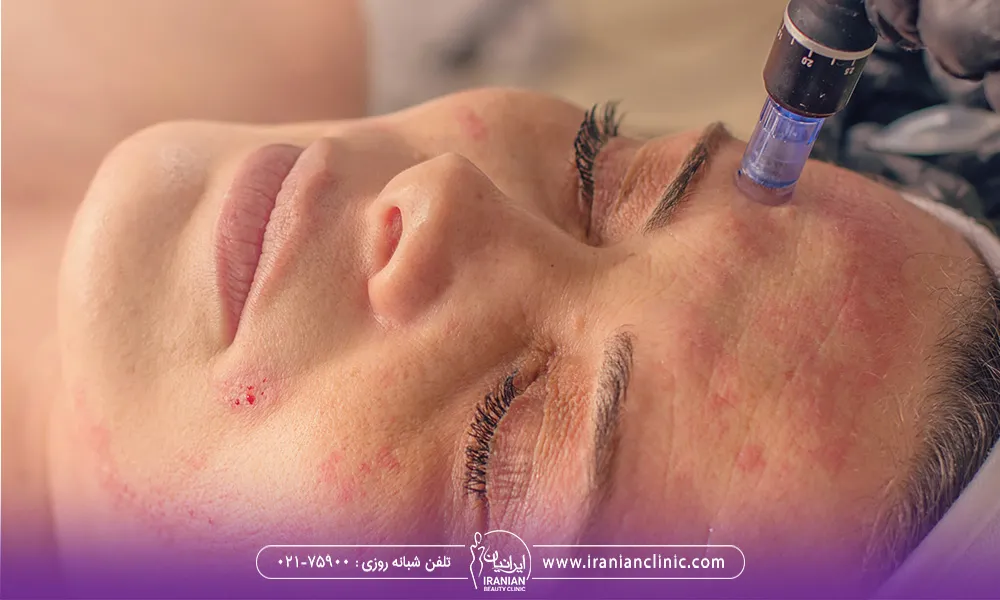خانمی که در حال انجام مزونیدلینگ بر روی پوست صورتش است برای از بین بردن جای جوش های صورتش