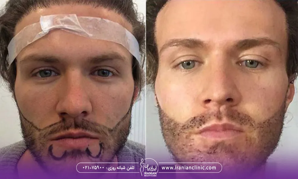 عکس قبل و بعد کاشت ریش یک آقا هست و روی عکس قبل محل کاشت ریش مشخص شده
