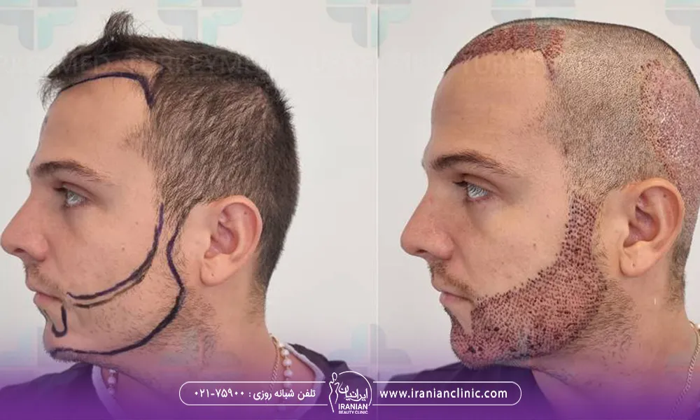 عکس قبل و بعد کاشت ریش یک آقای است و زخم های ایجاد شده بعد از کاشت روی صورتش مشخص هست.