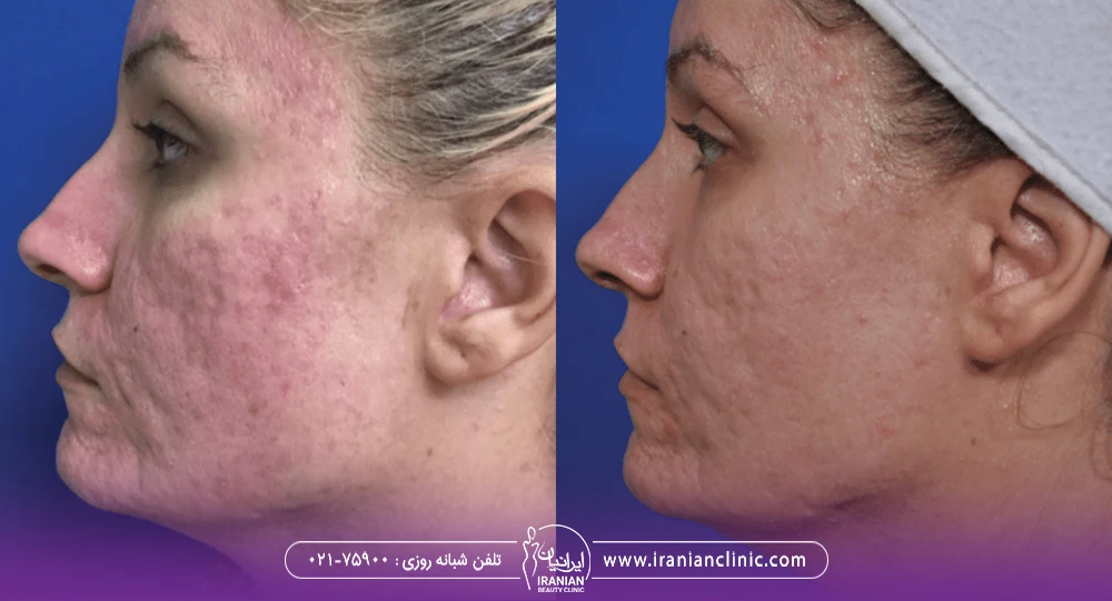 قبل و بعد مزونیدلینگ اسکار آکنه صورت زن