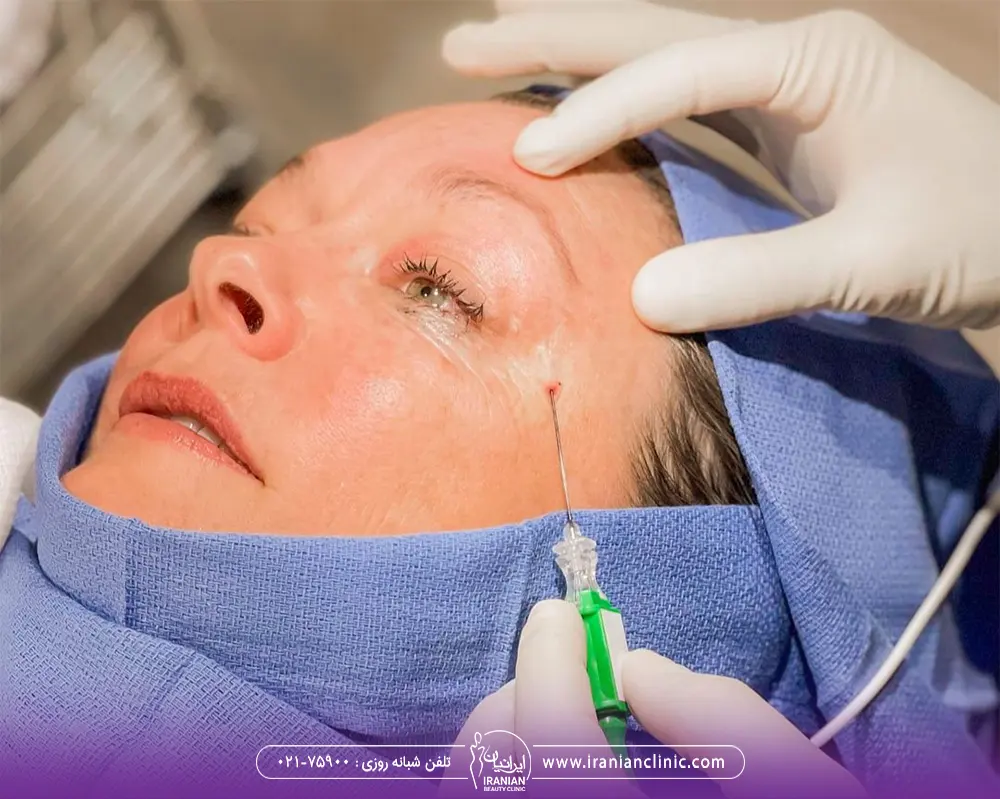 پزشکی که کانول اتیوا را در ناحیه شقیقه زن فرو می کند
