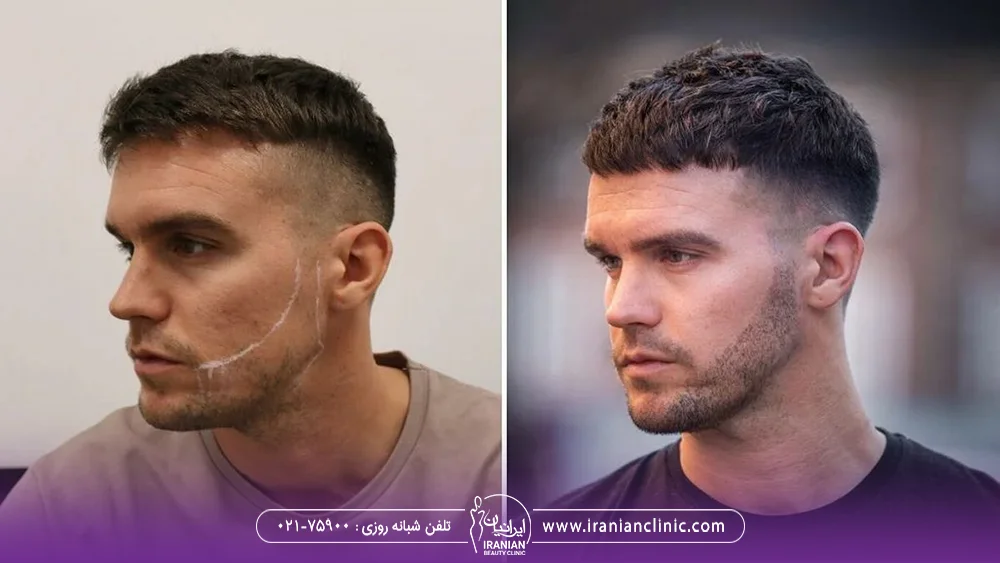 قبل و بعد مردی که کاشت ریش انجام داده است - کاشت ریش روی جای زخم و بخیه