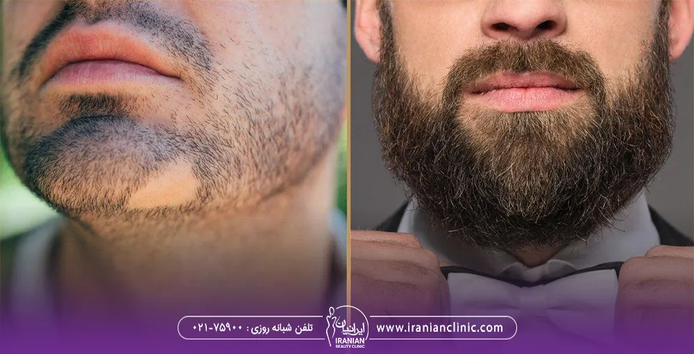 عکس قبل و بعد مردی که روی چانه اسکار داشته و روی آن کاشت ریش انجام داده است