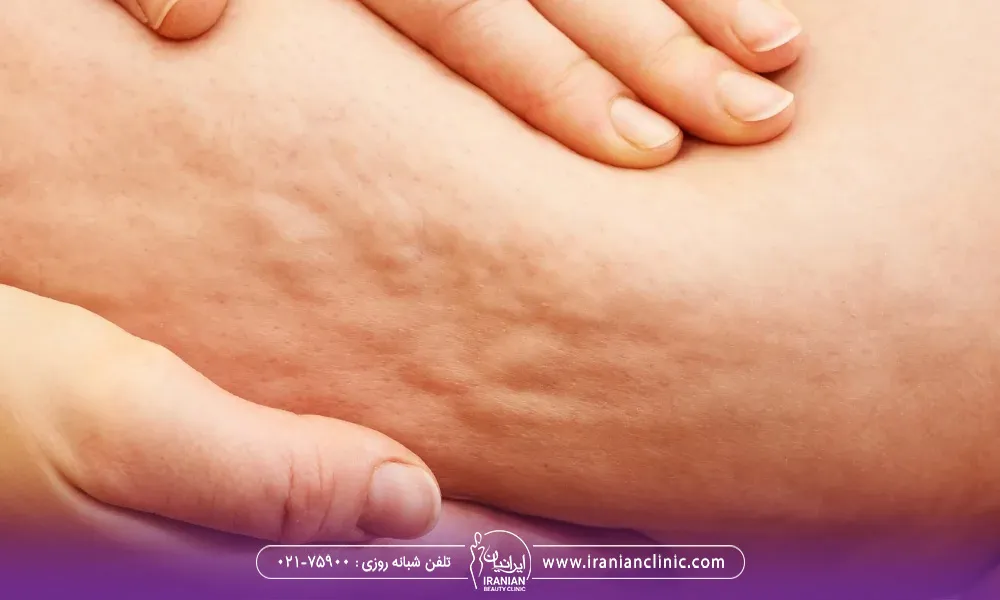 سلوایت های موجود بر روی پوست است