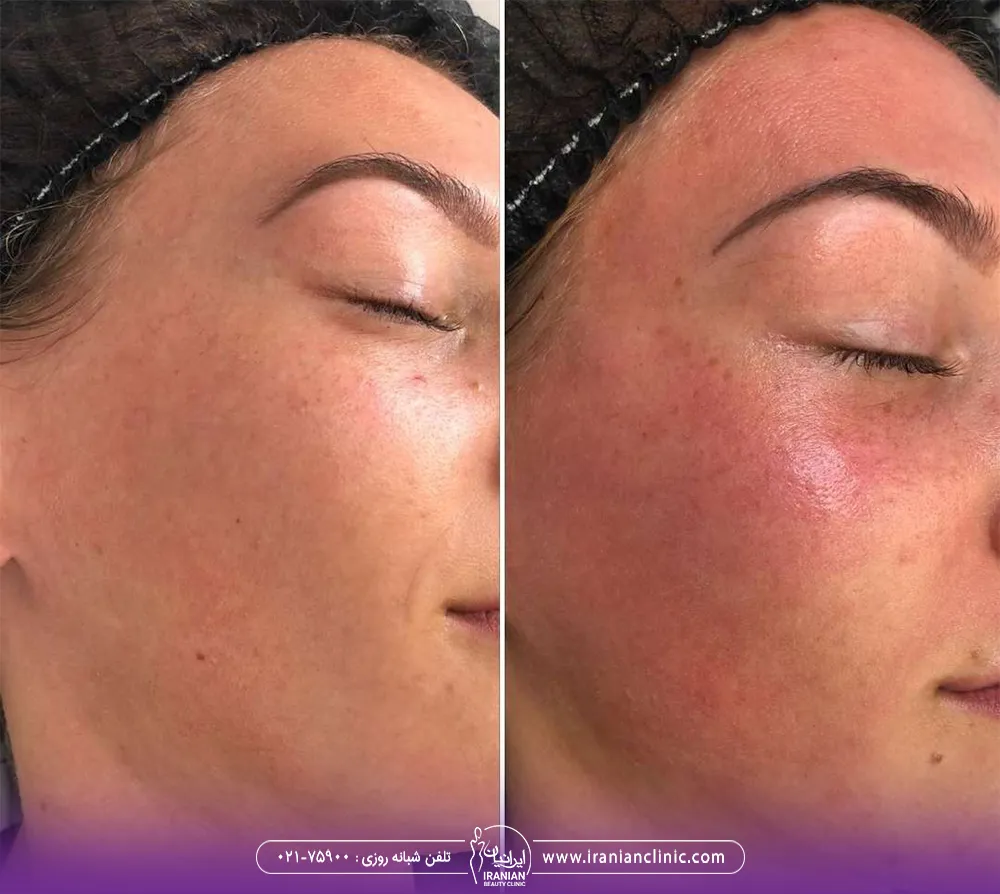 عکس قبل و بعد از مزونیدلینگ صورت دختری که پوست او بعد از مزو قرمز شده است