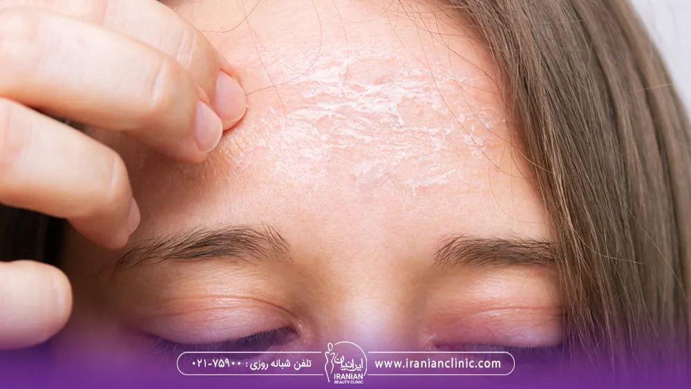 پیشانی دختری که پوسته پوسته شده است