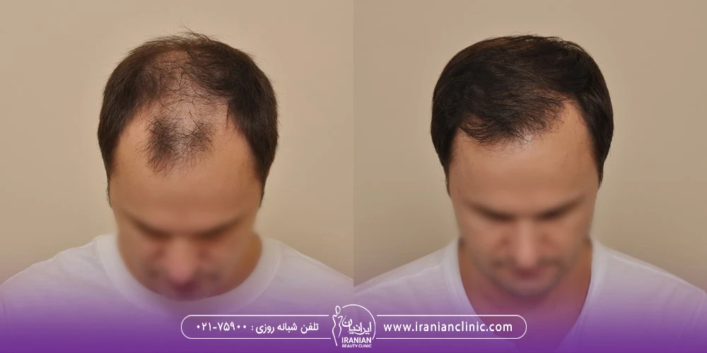 عکس قبل و بعد کاشت مو به روش FUT روی سر مرد که پیش از کاشت جلوی سر او طاس بوده اما بعد از کاشت به خوبی موهای او پر پشت شده است