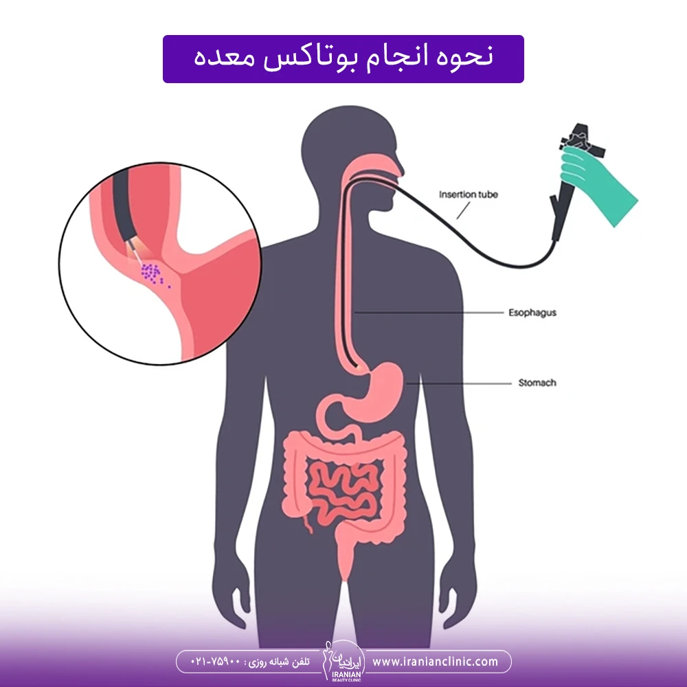 مراحل انجام تزریق بوتاکس معده
