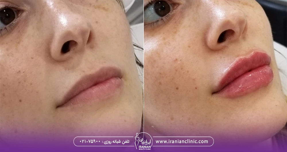 نتایج قبل و بعد تزریق ژل به لب های دختر