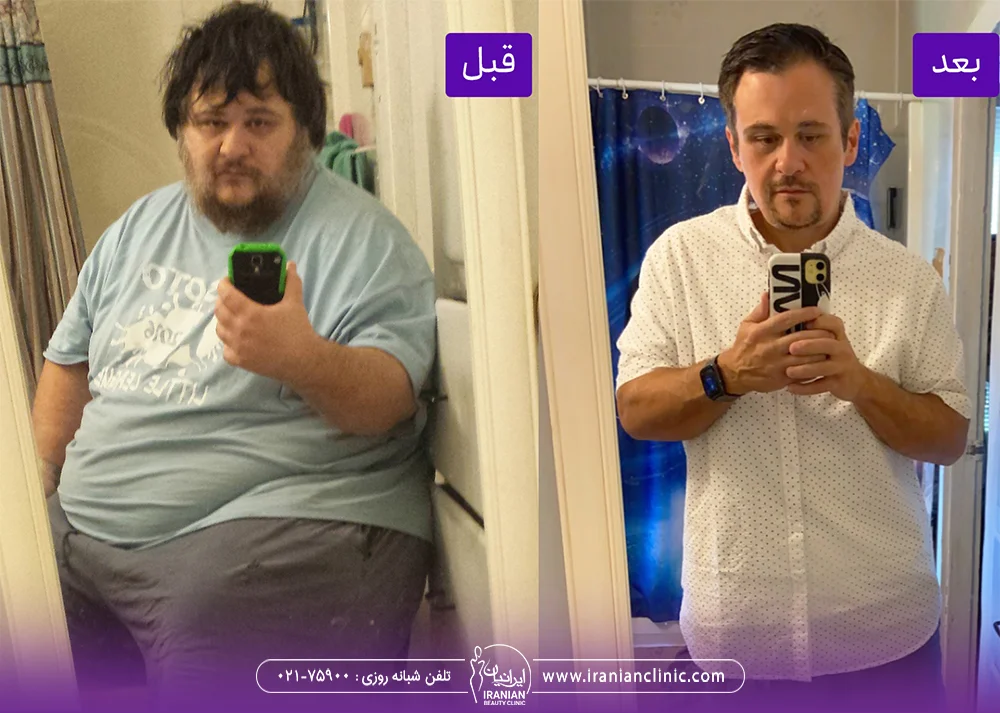 عکس قبل و بعد از کاهش وزن مرد با کمک بوتاکس معده