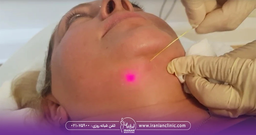 زنی که روی تخت خوابیده و پزشک غبغب او را اندولیفت می کند