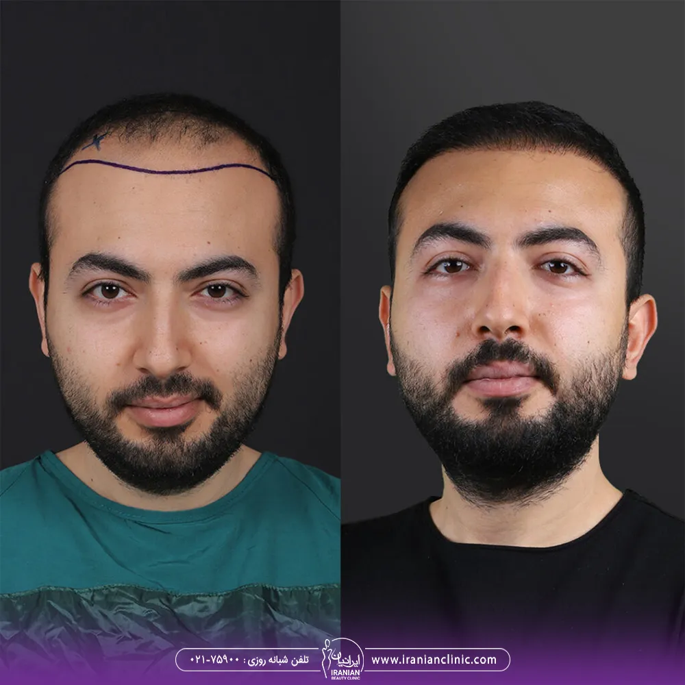 عکس قبل و بعد کاشت مو مرد جوان به روش تکثیر