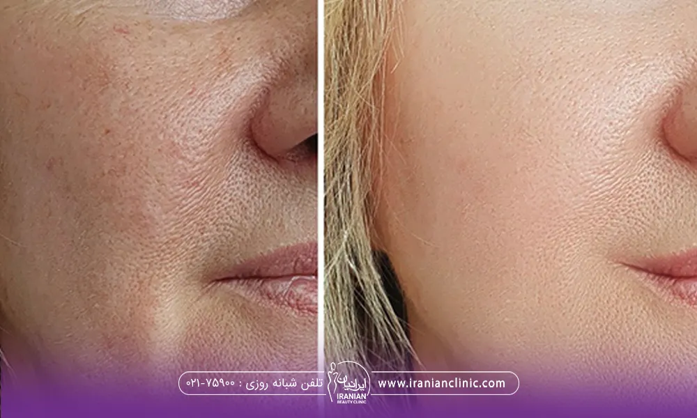 عکس قبل و بعد تزریق آبرسان به پوست صورت زن