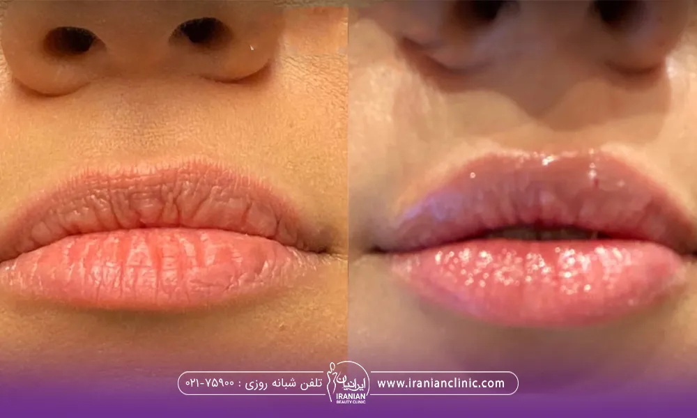 عکس قبل و بعد دختری که تزریق ژل لب انجام داده است