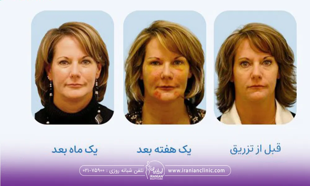 قبل، یک هفته بعد و یک ماه بعد از تزریق چربی به صورت زن میانسال