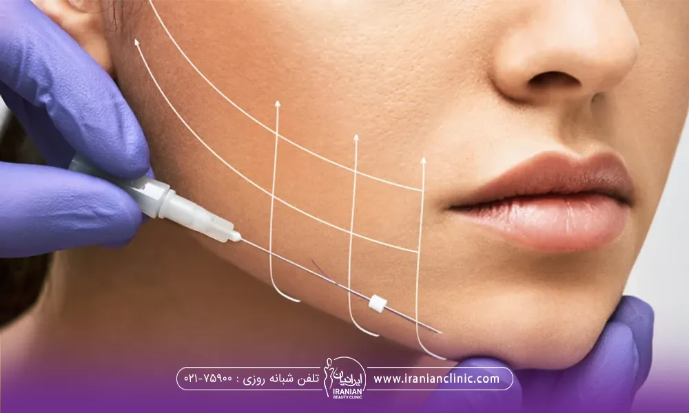 دختری که روی صورت او خط چین به رنگ سفید ترسیم شده است و پزشک نخ لیفت را در کنار صورت او قرار داده است - علائم پاره شدن نخ لیفت صورت