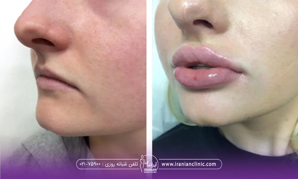 عکس قبل و بعد فردی که تزریق ژل لب انجام داده است