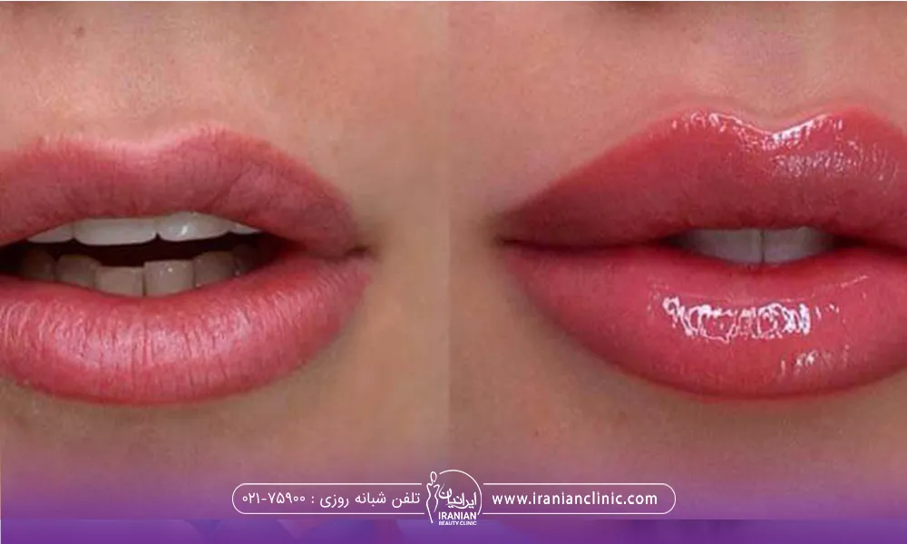عکس قبل و بهد فردی که ژل لب زده است