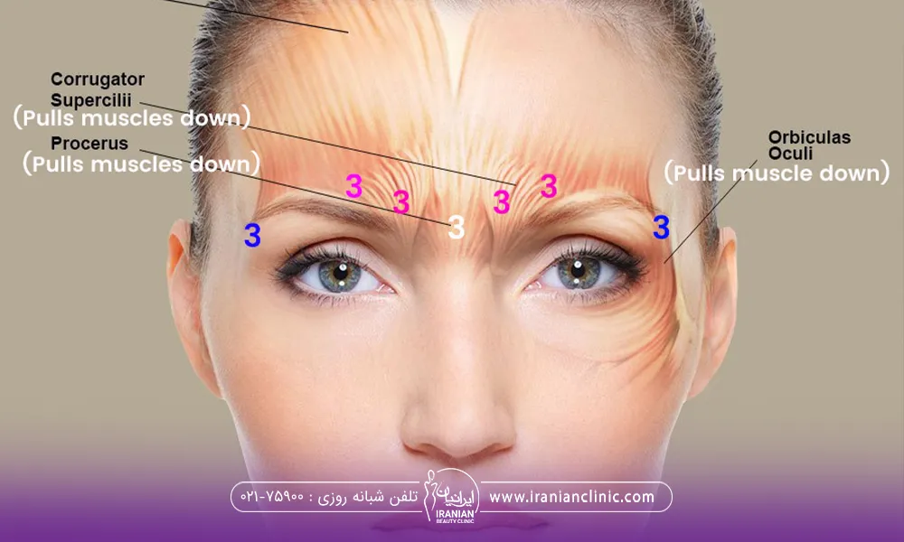 عکس خانمی که روی صورتش نقاط تزریق بوتاکس ابرو مشخص شده است