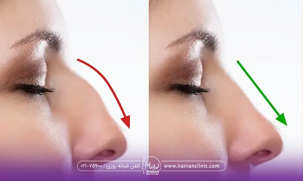 عکس قبل و بعد دختری که عمل بینی انجام داده است و قوز بینی او رفع شده است