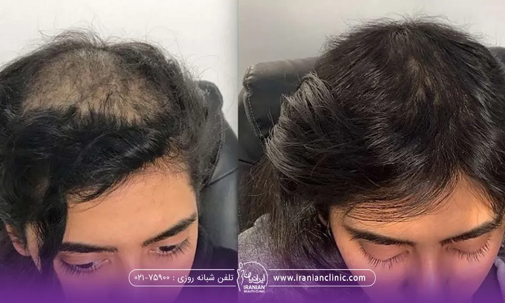 عکس قبل و بعد دختری که پی آر پی مو انجام داده است و قبل از تزریق موهای او خیلی کم پشت بوده و بعد از تزریق موهایش پر پشت شده است