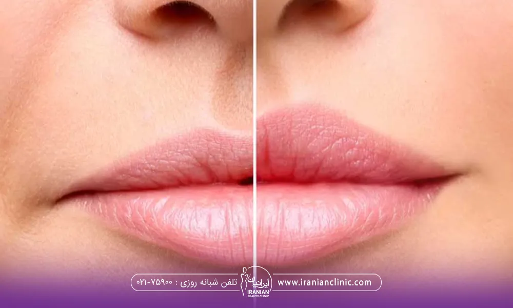 عکس قبل و بعد دختری که تزریق ژل لب انجام داده است