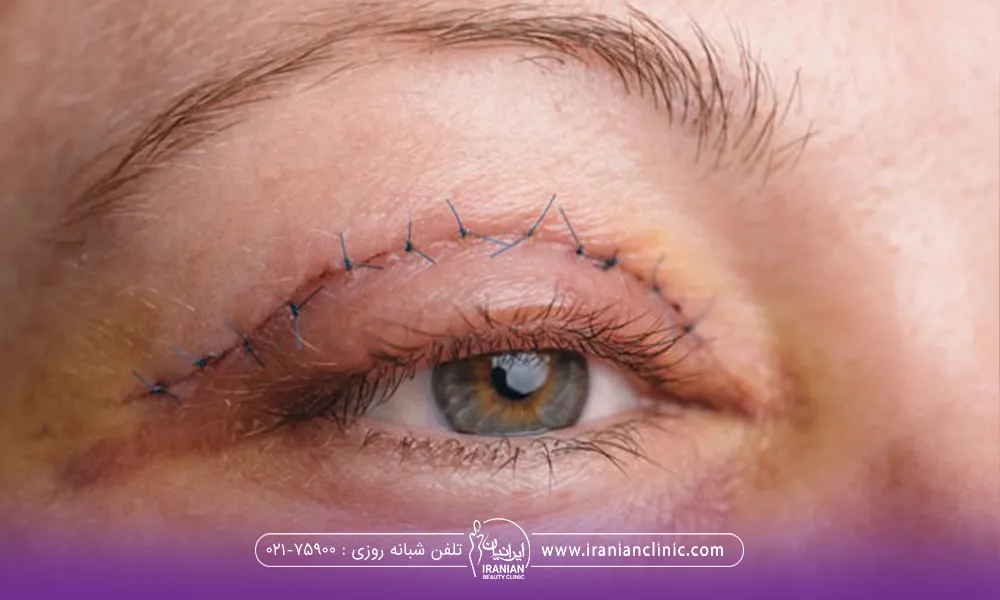 فردی که بخیه روی چشمش است و به یک نقطه نگاه میکند و نخ بخیه از پوست او بیرون زده است - مراقبت های بعد از بلفاروپلاستی