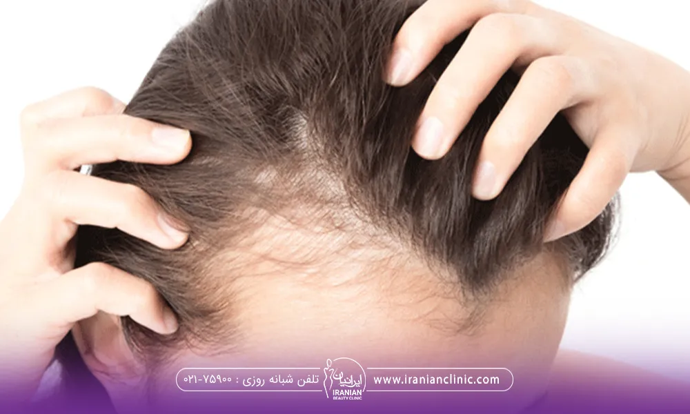 دختری که موهای خود را با دو دستش گرفته است و موهای ناحیه شقیقه او کم پشت شده است