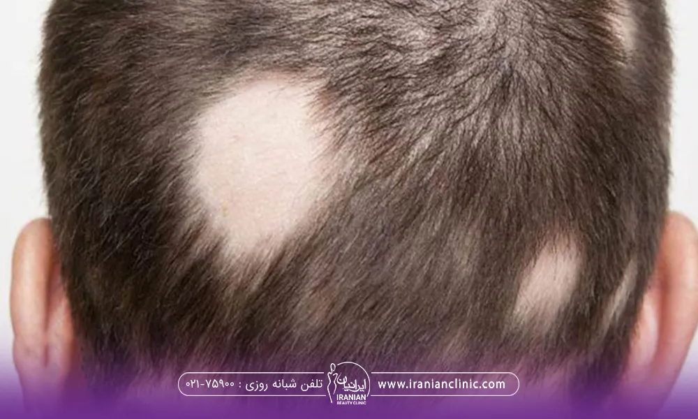 تصویر از پشت سر مرد که در 4 نقطه مختلف دچار ریزش موی سکه ای شده است