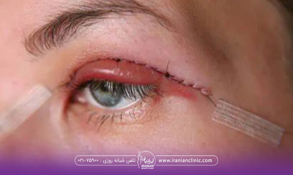 چشم فردی که عمل بلفارو کرده است و بالای پلک او بخیه خورده است