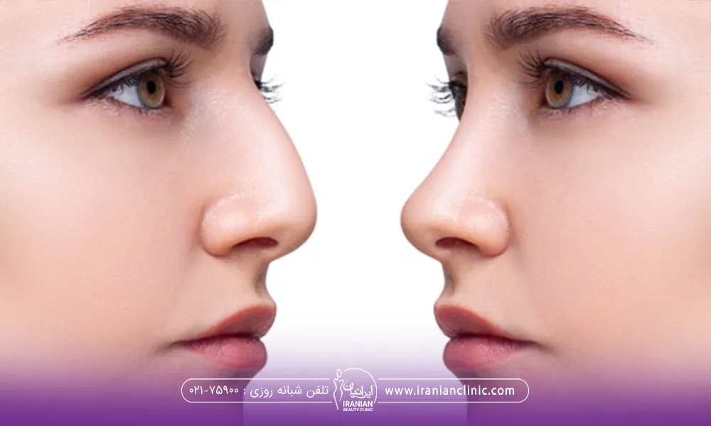 عکس قبل و بعد دختری که تزریق آنزیم بینی انجام داده است و بینی او کوچک شده است