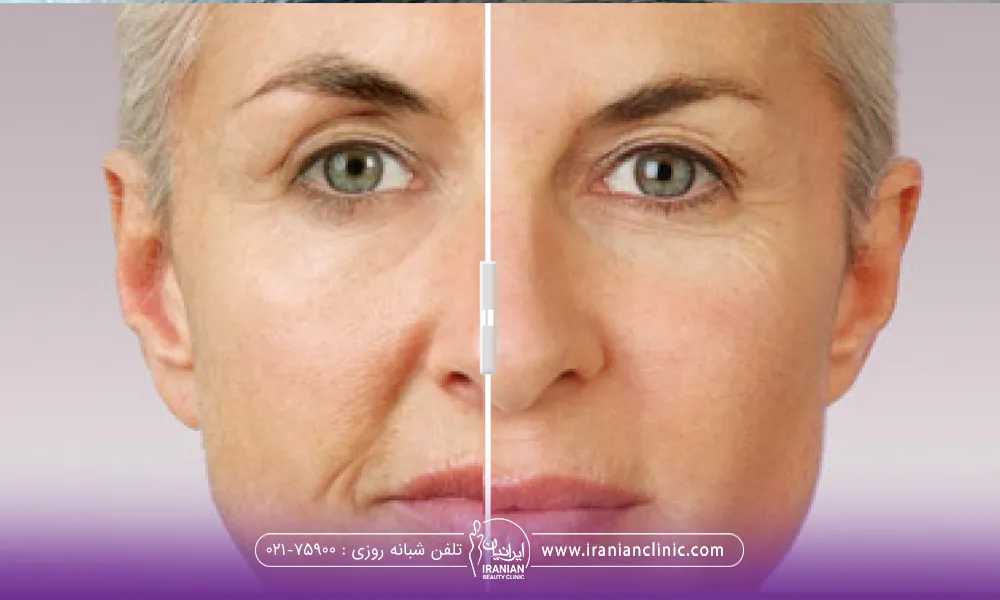 عکس قبل و بعد زنی که تزریق چربی به خط خنده انجام داده است