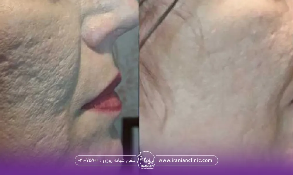عکس قبل و بعد رفع اسکار آکنه با سابسیژن با اندولیفت