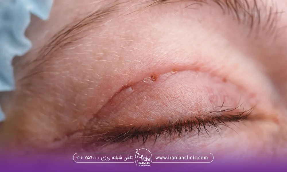فردی که چشم هایش بسته است و بخیه چشمش را کشیده است و جای بخیه بالای پلک چشم او باقی مانده است