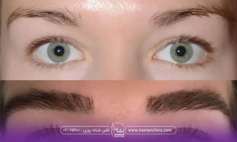 عکس قبل و بعد دختری که کاشت ابرو انجام داده است