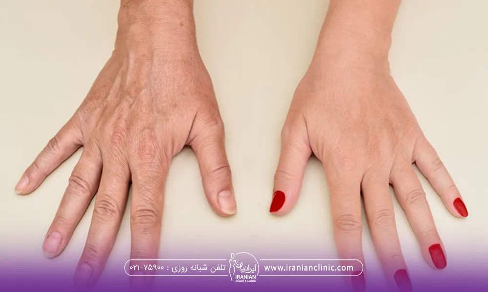 عکس قبل و بعد جوانسازی دست یک زن