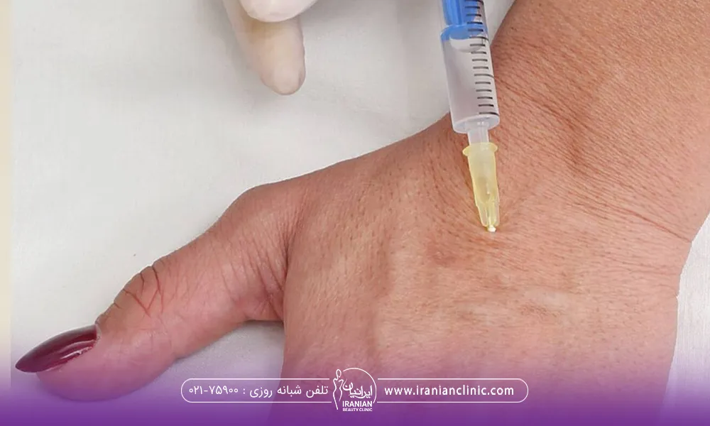 دست چپ فردی که پزشک به آن فیلر تزریق می کند