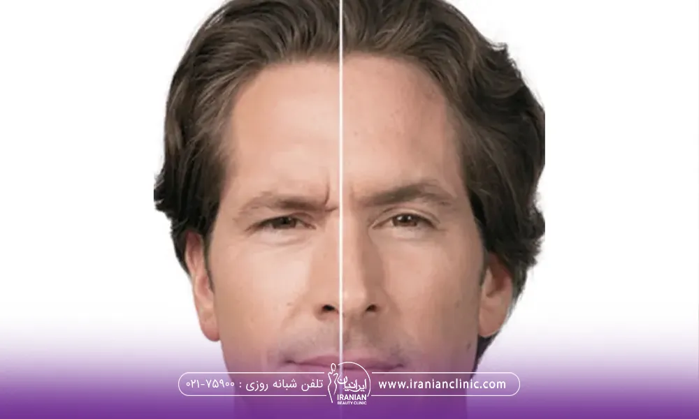 عکس قبل و بعد مردی که تزریق بوتاکس انجام داده است
