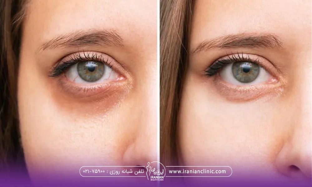 عکس قبل و بعد اگزوزوم زیر چشم دختر - اگزوزوم