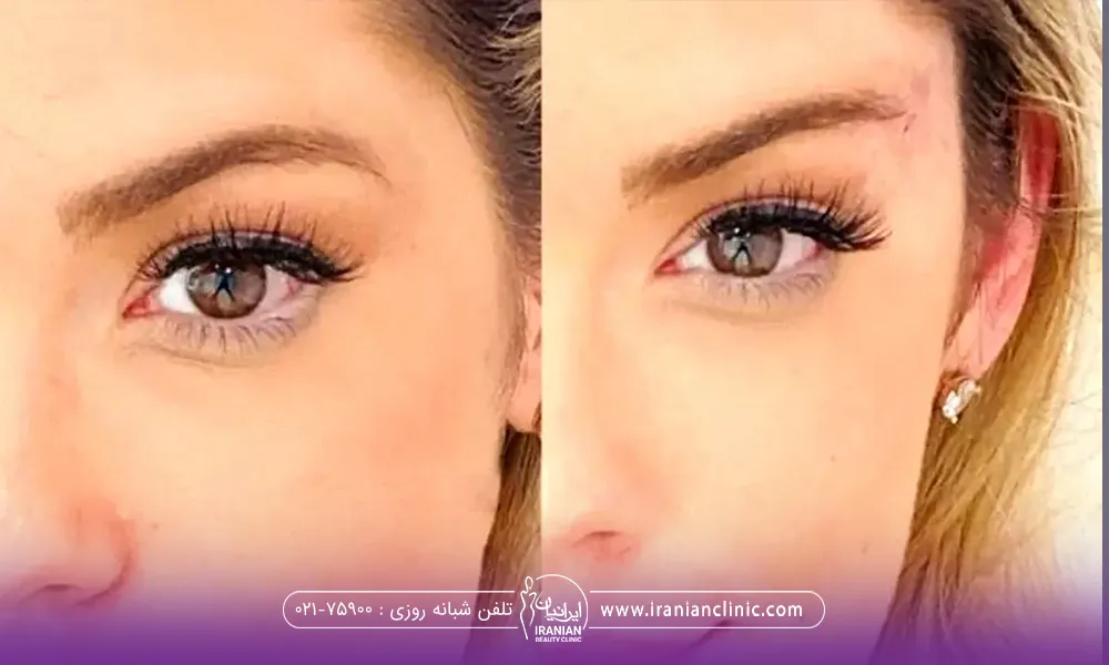 عکس قبل و بعد دختری که تزریق چربی به شقیقه انجام داده است