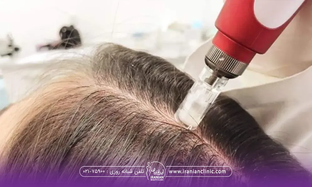 سر فردی که فرق وسط دارد و دستگاه microneedling روی سر او قرار گرفته است