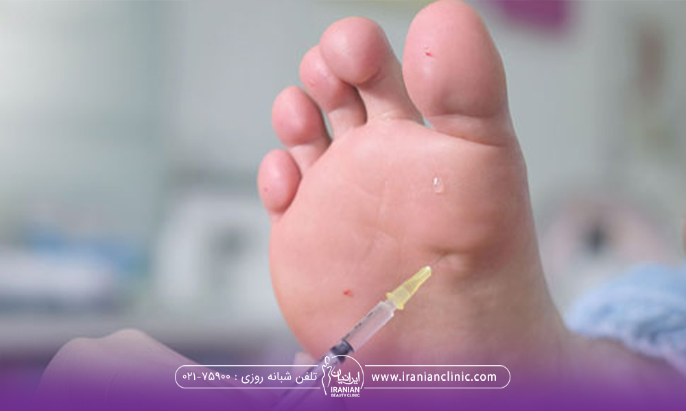 دلایل تعریق بیش از حد پا