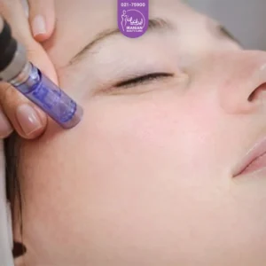 دختری که چشم هایش را بسته است و دست اپراتوری که در حال انجام Microneedling چشم است - میکرونیدلینگ دور چشم​