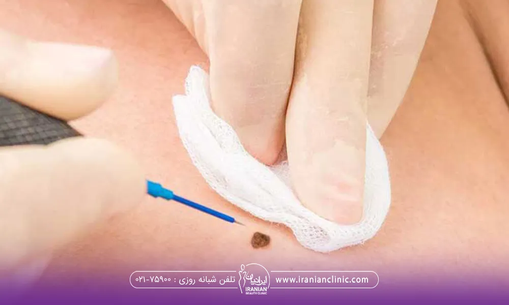 دکتری که با یک دست گاز را روی صورت نگه داشته است و با دست دیگر تیغ جراحی دستش است و خال فردی را بر می دارد