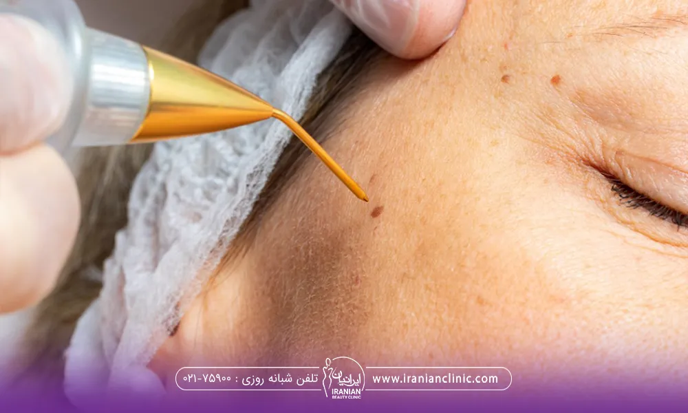 پزشکی که با ابزار مخصوص خال صورت زن را از بین می برد