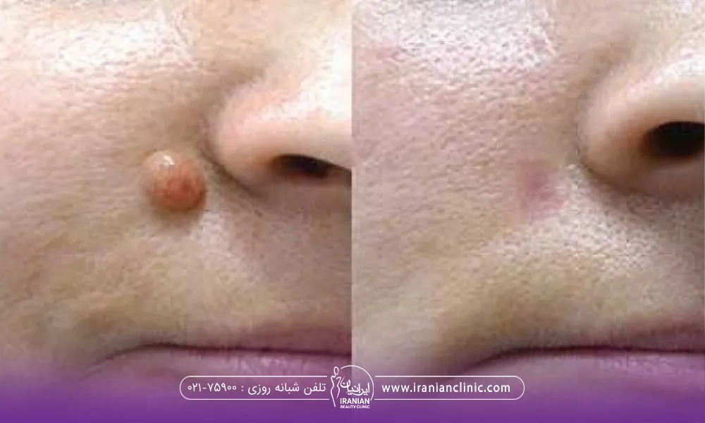 عکس قبل و بعد فردی که خال خود را ریمو کرده است