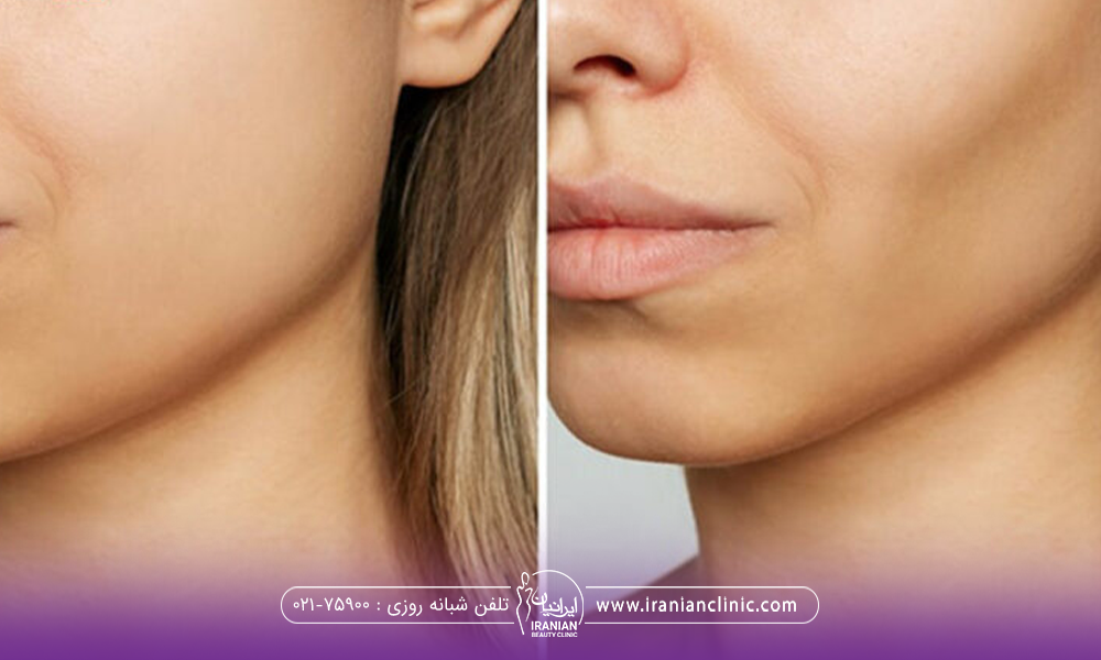 عکس قبل و بعد دختری که بوکال فت انجام داده است